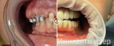 до лечения после лечения, фото, импланты, пример. Полное протезирование верхней челюсти и имплантация в стоматологии «Имплантмастер»