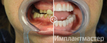 Восстановление все зубов на верхний челюсти, методом имплантации все на 6 с протезированием нижней челюсти коронками Е-Мах до после