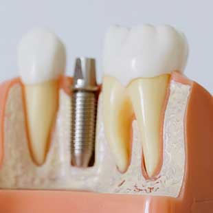 Что нужно знать перед имплантацией или как подготовится к имплантации зубов