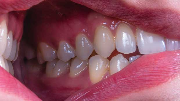 Что такое перикоронарит в стоматологии