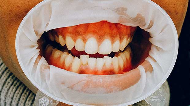 Что такое Сверхкомплектные зубы