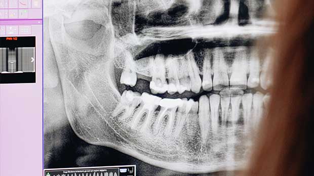 Как понять что у вас Сверхкомплектные зубы
