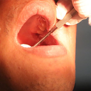 Острый перикоронит перикоронарит зуба мудрости диагностика лечение стоматология в москве отзывы
