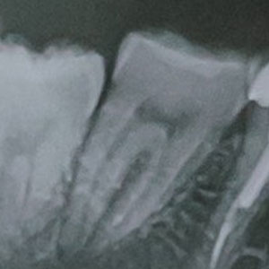 Прицельный снимок зубов как выглядит