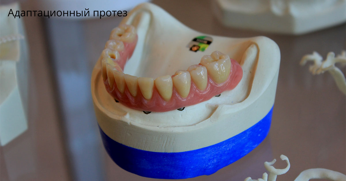 Протезирование после удаления зубов в СПб, цены на протезы в стоматологиях