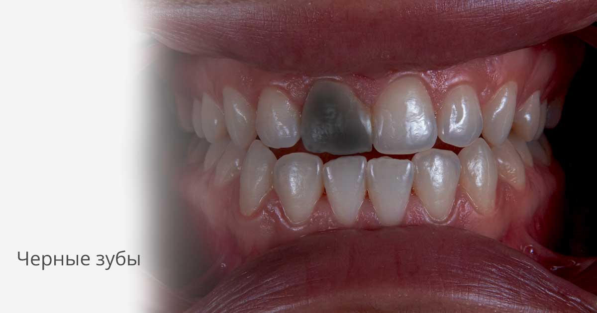 Черный налет на зубах: как убрать?