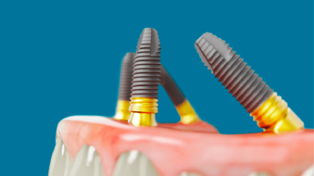 Импланты Nobel Biocare концепция All-on-4 при отсутствии всех зубов