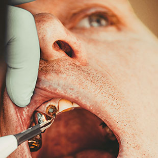 Крошатся зубы: причины и как остановить разрушение коронки — ROOTT