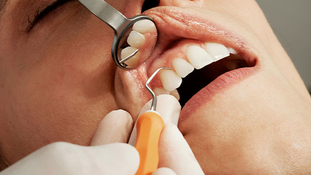 Определение болезни флюороз зубов