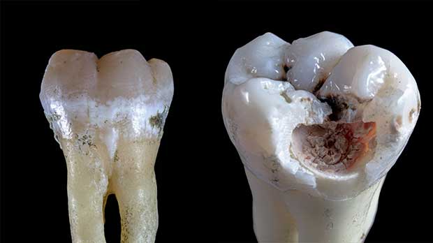 Гнилые зубы имеет следующие стадии развития