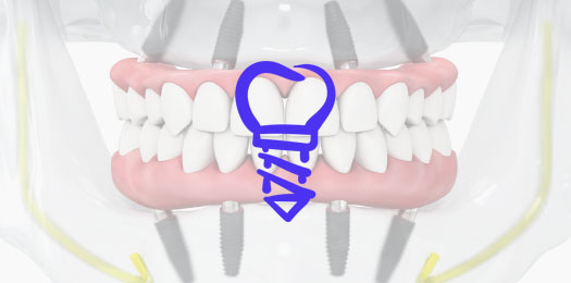 Имплантация при полном отсутствии зубов (по системе All-on-4 и All-on-6)