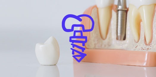 Коронки на имплантаты в стоматологии