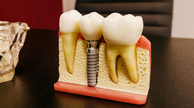 Протезирование зубов на титановых дентальных имплантах