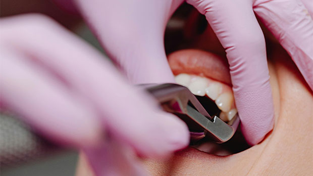 В каких случаях возникает отек после удаления зуба?