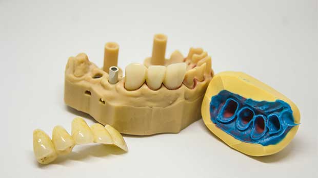 Виды поломок зубных протезов
