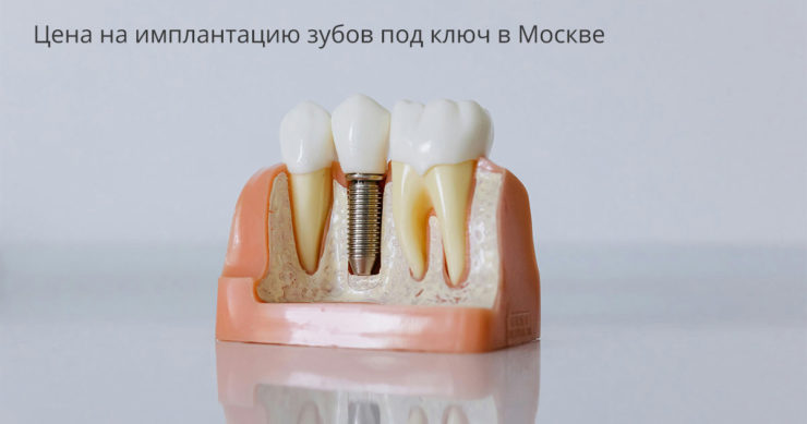 Цена на имплантацию зубов под ключ в Москве