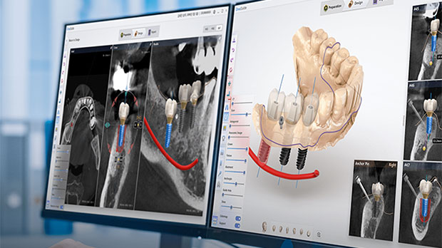 Что такое одномоментная имплантация зубов после удаления зуба ?