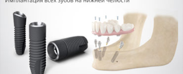 Имплантация всех зубов на нижней челюсти