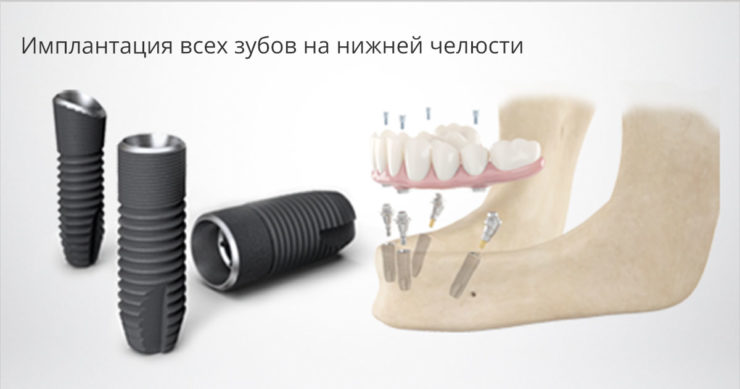 Имплантация всех зубов на нижней челюсти