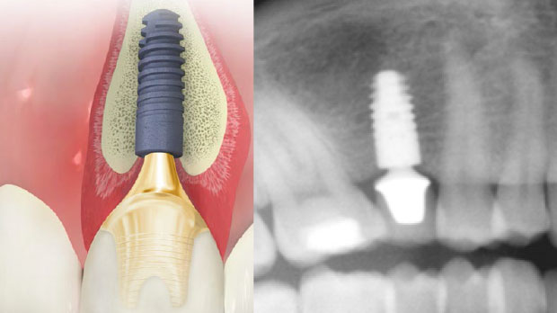 Как делается одноэтапная имплантация зубов с немедленной нагрузкой