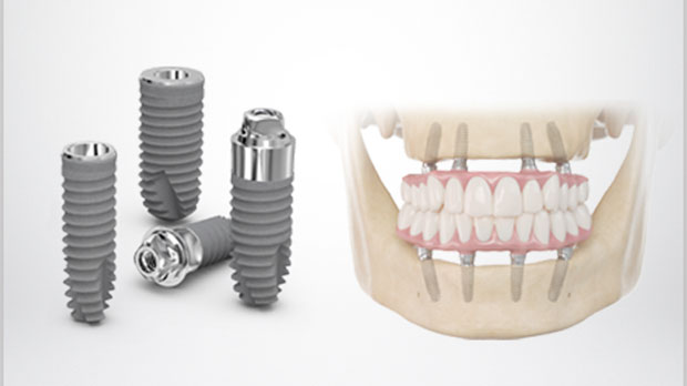 Какие особенности и преимущества имеет полная имплантация зубов
