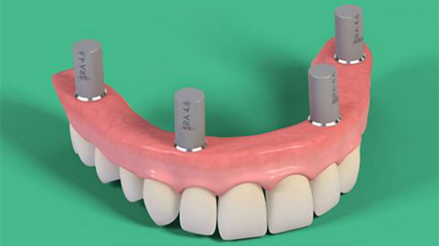 Метод «All-on-4» при полной имплантации зубов верхней челюсти