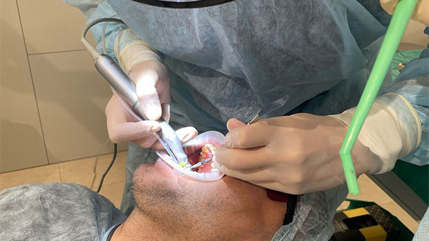 Методики или как проводится имплантация зубов на верхней челюсти
