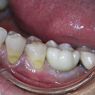 Наращивание костной ткани перед имплантацией зубов