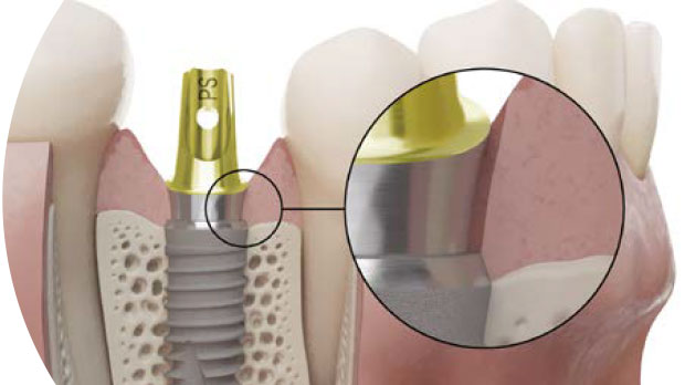 Одномоментная или двухэтапная имплантация зубов, что лучше?