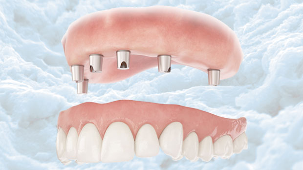 Почему имплантация зубов верхней челюсти является отличным решением