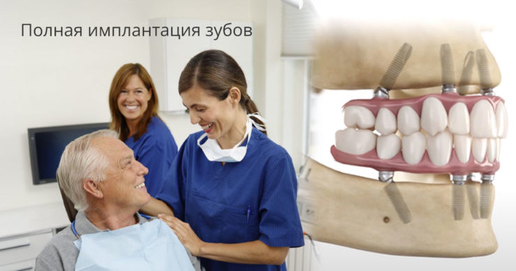 Полная имплантация зубов