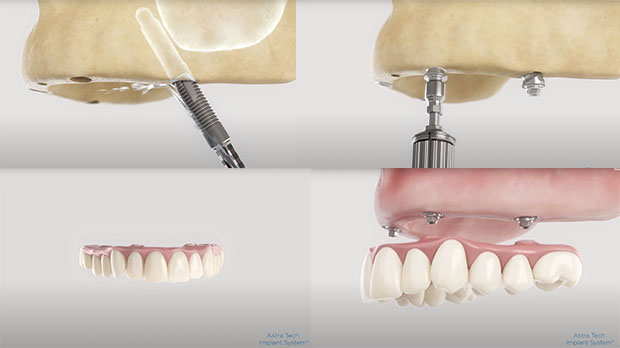 Полная имплантация зубов и ее этапы