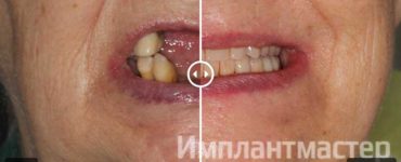 полный съёмный зубной протез фото отзывы пример работ стоматология в Москве До После