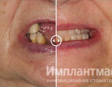 полный съёмный зубной протез фото отзывы пример работ стоматология в Москве До После