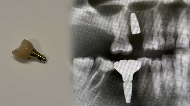 Чем выделяется имплантация жевательных зубов нижней челюсти
