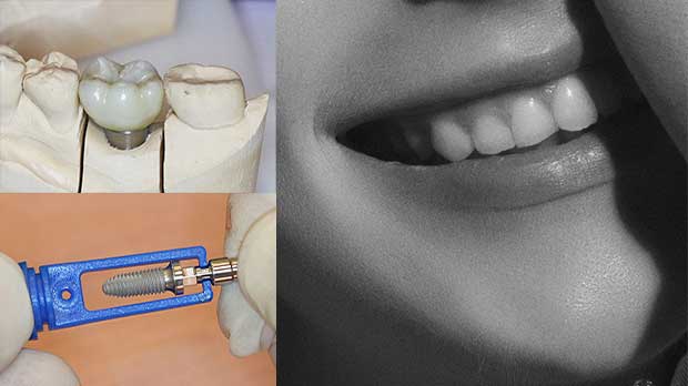 Имплант жевательного зуба отзывы пациентов