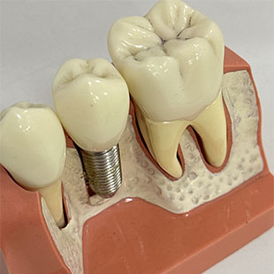 Коронки или импланты на жевательные зубы?