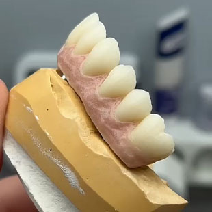 Имплантация всех зубов на нижней челюсти стоматология цена методика в Москве