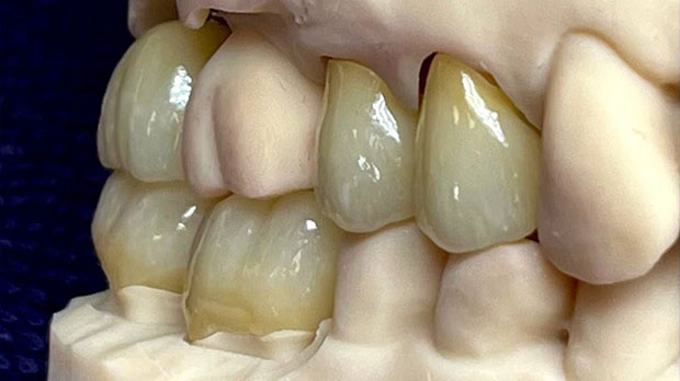 Керамические коронки на жевательные зубы