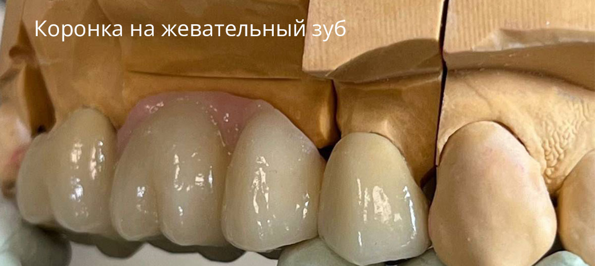 Замена старых зубных коронок. В каком случае нужно менять коронки?