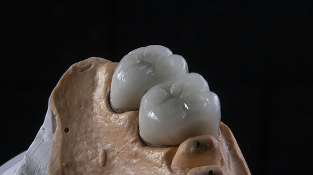 Металлокерамическая коронка на зуб