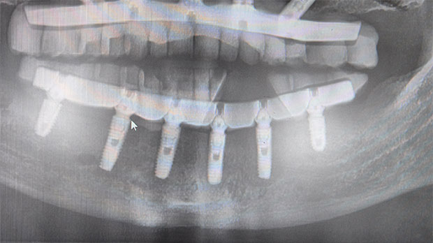 Методы которыми проводится имплантация зубов на нижней челюсти