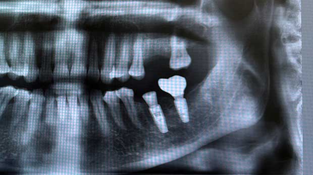Почему при потере коренного зуба необходимо ставить имплант на жевательный зуб?