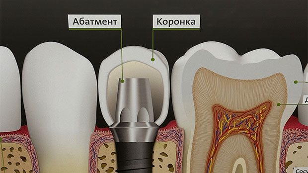 Установка импланта на передний зуб с коронкой