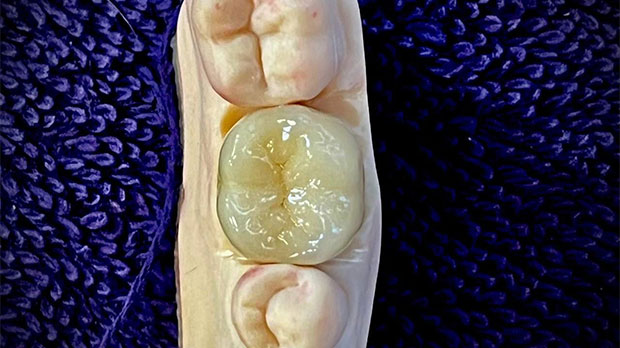 Виды коронок на задние зубы Циркониевые коронки на жевательные зубы