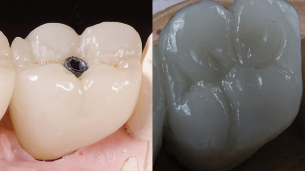 Чем отличается коронка на имплант от зубной коронки