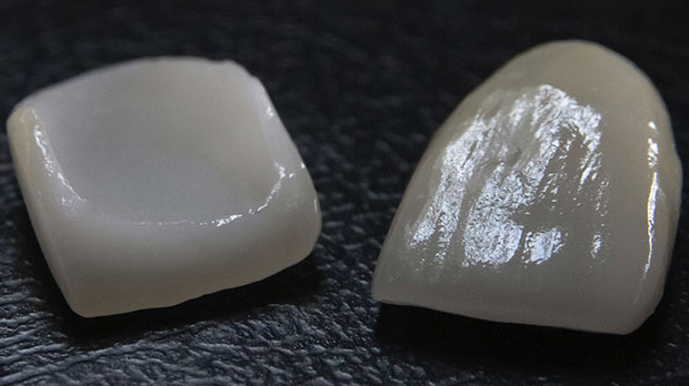 Что такое керамические виниры в стоматологии?