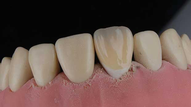 Что такое композитные виниры на зубы?