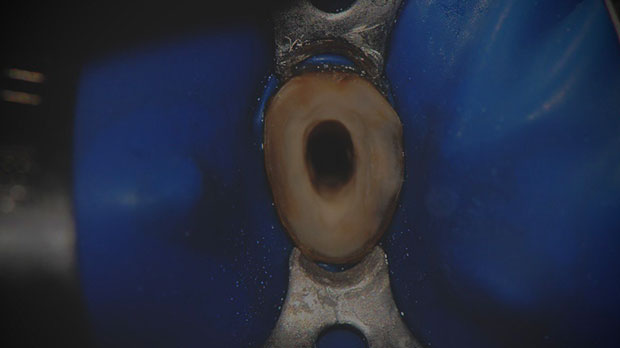 Что такое зубные корневые каналы? фото