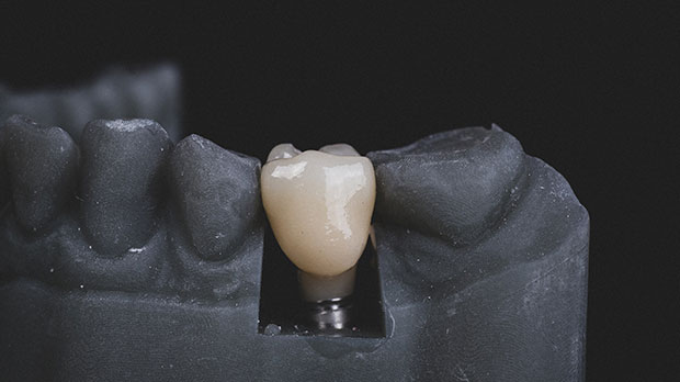 Что такое зубные коронки из диоксида циркония?